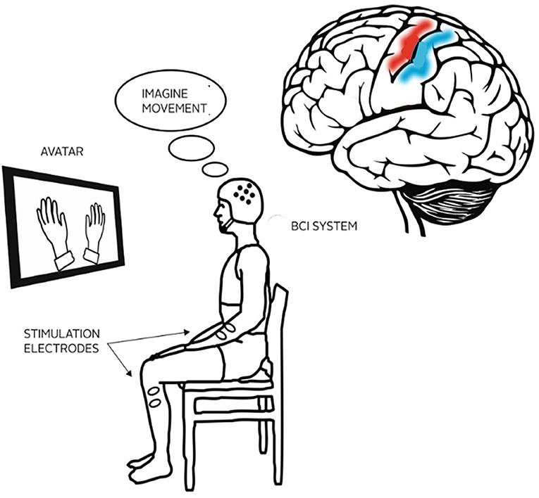 图1——BCI治疗,中风患者佩戴电极帽和查看监控图像,例如移动的手,帮助他们重新学习如何移动。